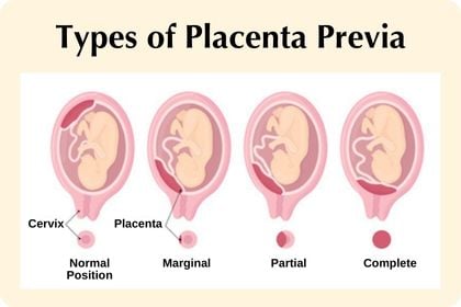 Programmi Alla Tv Stasera – placenta previa: causes, symptoms and treatment