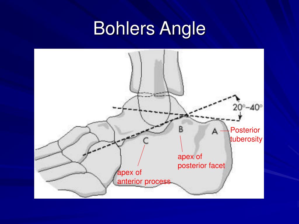 Vorlage: PPT - Hindfoot Fractures PowerPoint Presentation, free download - ID:443040 PPT - Hindfoot Fractures PowerPoint Presentation, free download - ID:443040 Bildidee